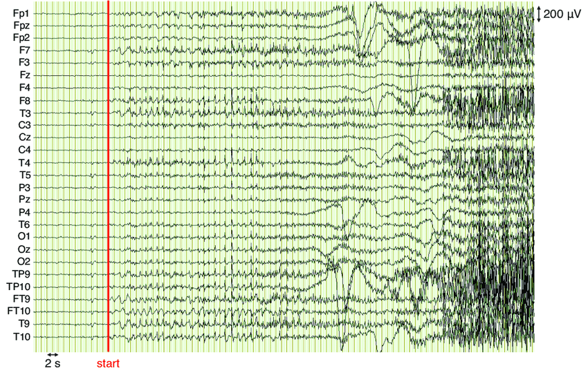 רישום EEG של פירכוס