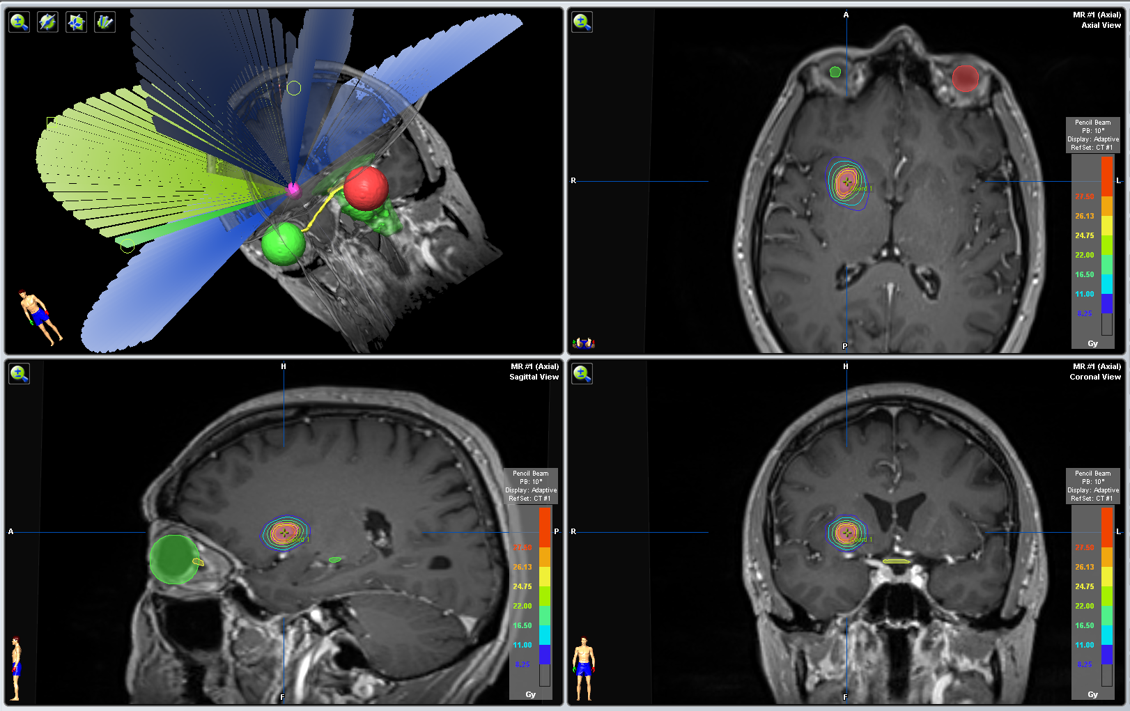 רדיוכירורגיה לגידול מוחי