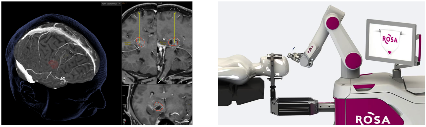 ביופסיה רובוטית